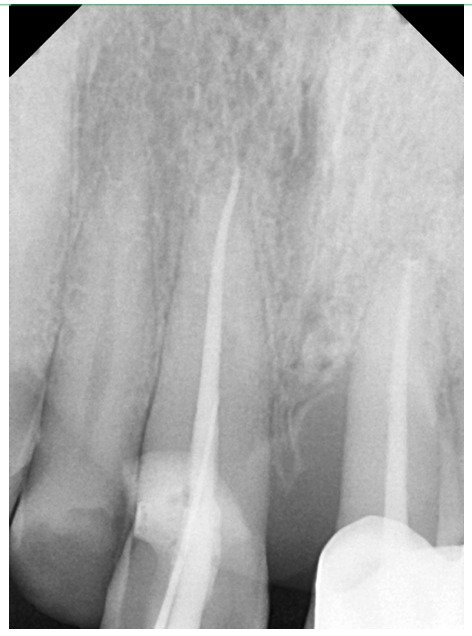 X-ray taken during treatment showing root canal–treated upper front teeth before the zirconia bridge