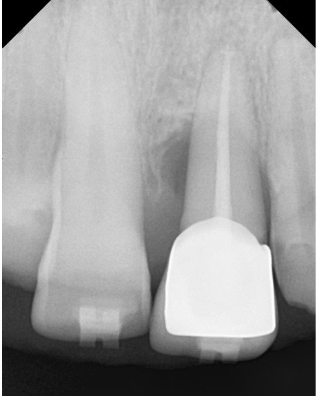 Before treatment X-ray of the upper front teeth showing a root canal–treated crowned tooth 21 with bone loss