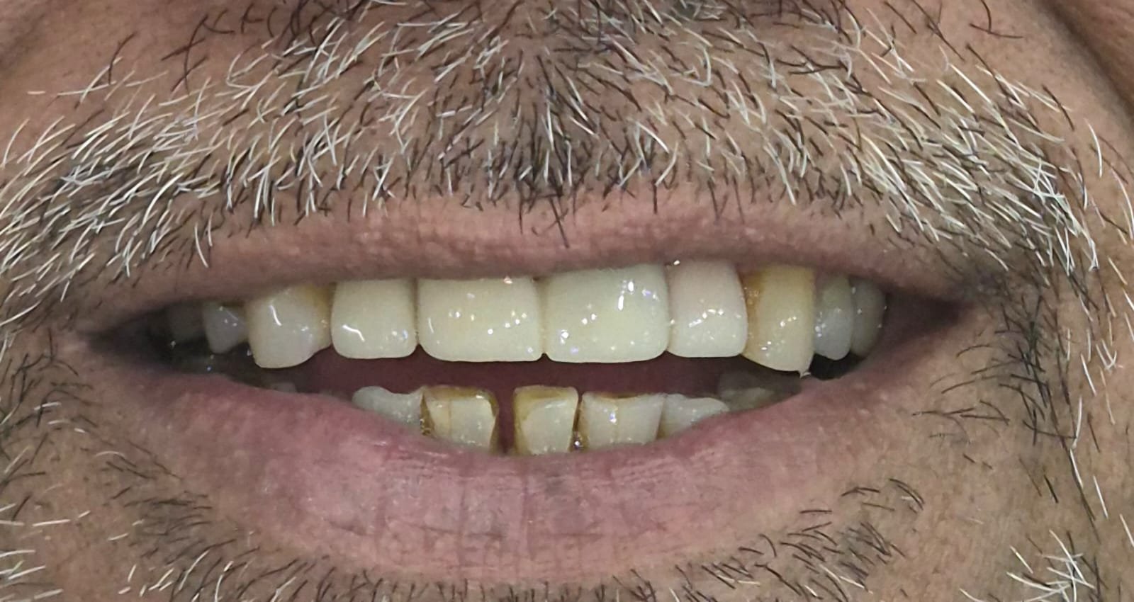 After treatment: upper front teeth restored with a 3-unit zirconia bridge on 11, 21, 22 and an Emax veneer on 12, with spacing closed